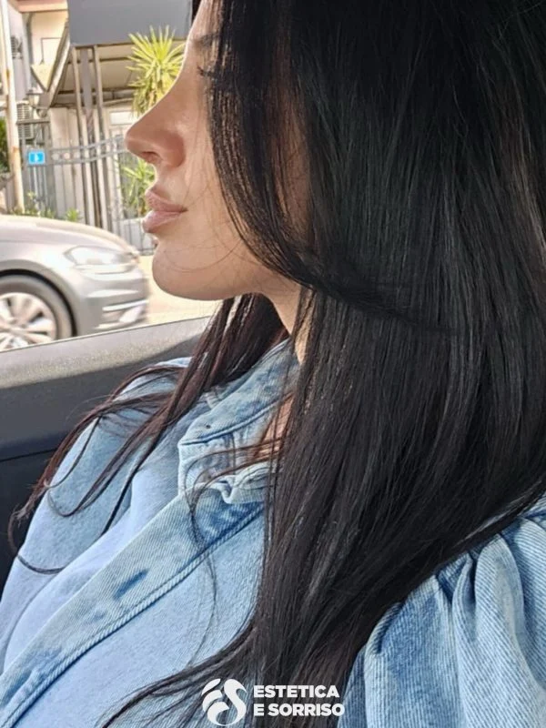 Rinoplastica - Estetica e Sorriso