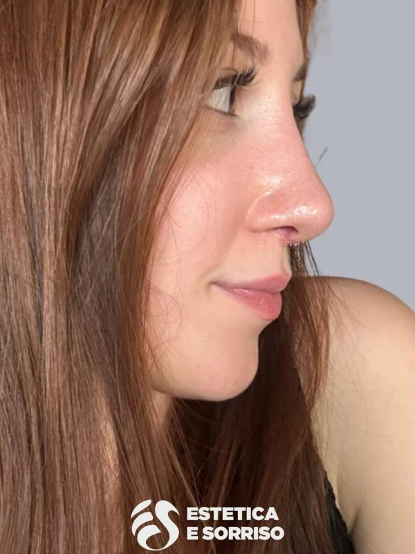 Rinoplastica - Estetica e Sorriso