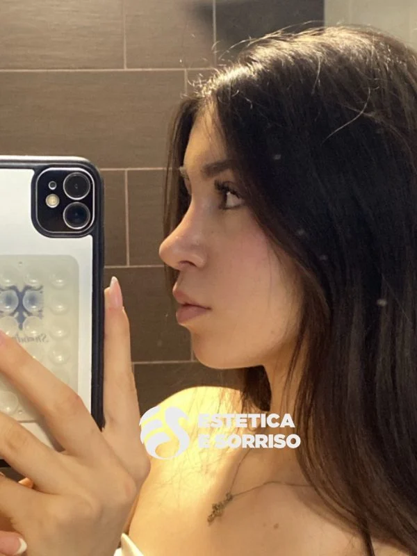 Rinoplastica - Estetica e Sorriso